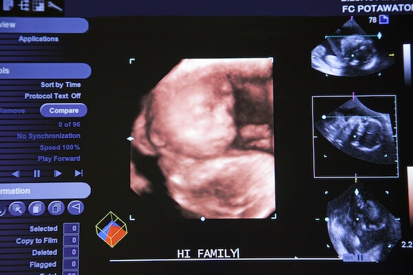 ultrasound image